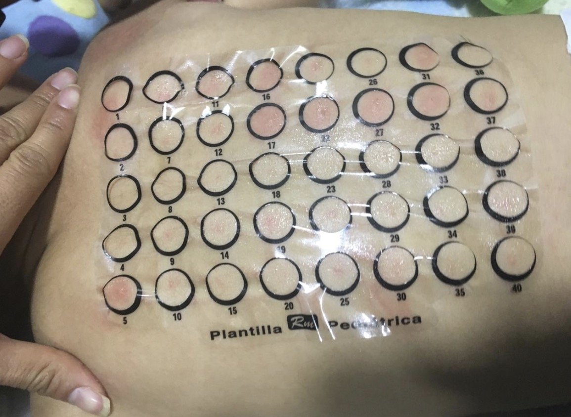 Pruebas cutáneas Prick